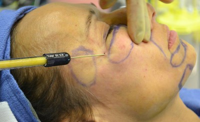 Photographie lipofilling du visage au bloc opératoire