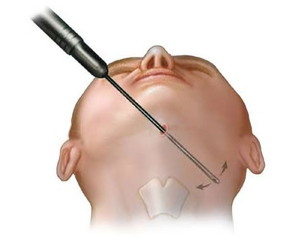 description de la technique de liposuccion du cou avec canules