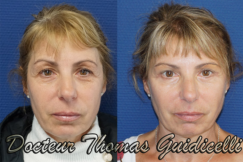 Résultat blépharoplastie avec botox acide