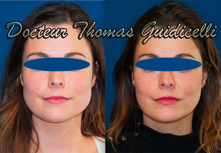 avant après botox masseters