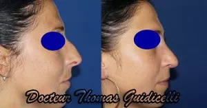Rhinoplastie