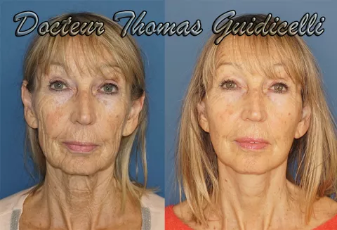 Photo avant après un lifting du visage et du cou