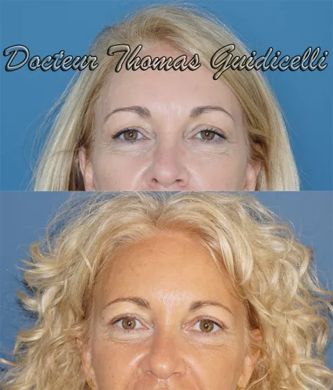 Avant après une blépharoplastie à Marseille