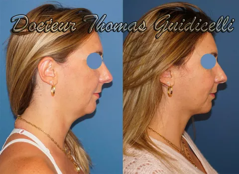 Traitement du double menton par l’association d’une liposuccion du cou à des fils tenseurs permanents, sous anesthésie locale