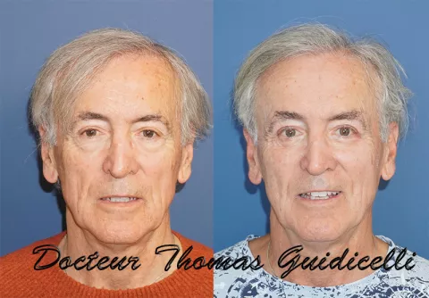 Résultat d'une blépharoplastie 4 paupières