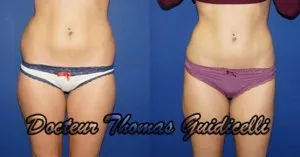 Liposuccion