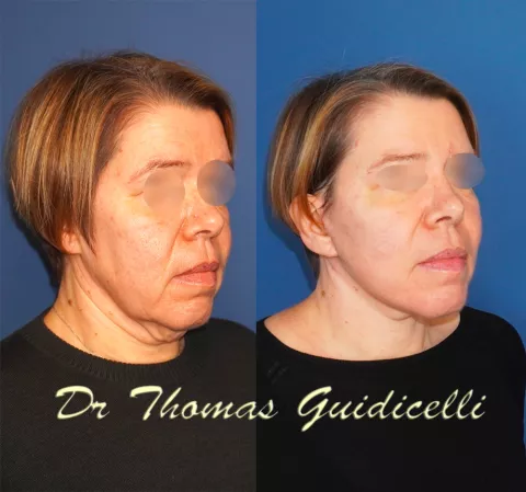 Lifting visage et cou type Extended Deep plane facelift avec lipofilling