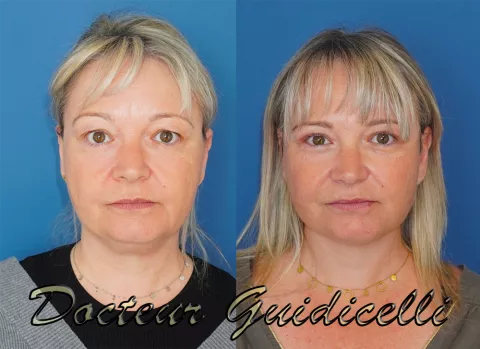 Avant après deep plane facelift