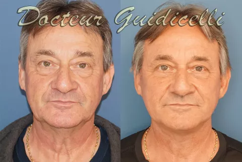 Photo avant après un lifting du visage et du cou homme