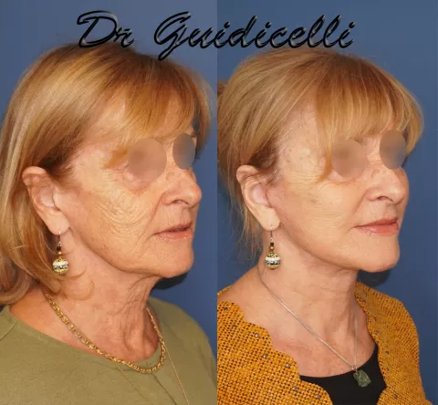 Lifting visage et cou type Extended Deep plane facelift avec lipofilling