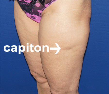photographie d'un capiton de cuisse