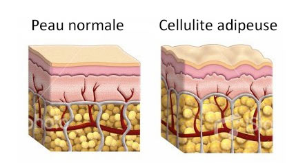 schéma de cellulite adipeuse