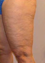 cellulite des cuisses