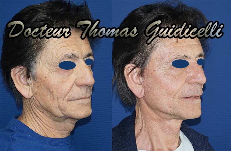 photo avant après un lifting du visage et du cou chez un homme
