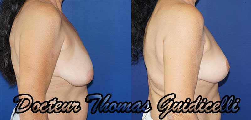 photo avant après un lifting des seins ou cure de ptose mammaire de profil