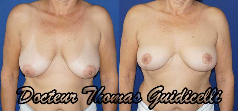 photo avant après un lifting des seins ou cure de ptôse mammaire