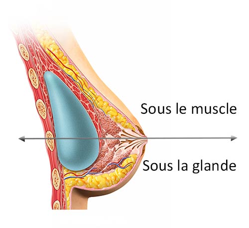 schéma dual plan prothèse mammaire