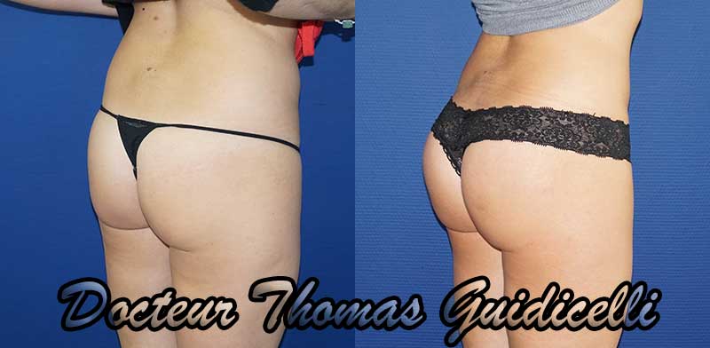 Photo avant après des implants fessiers de 230cc, prothèses de fesses