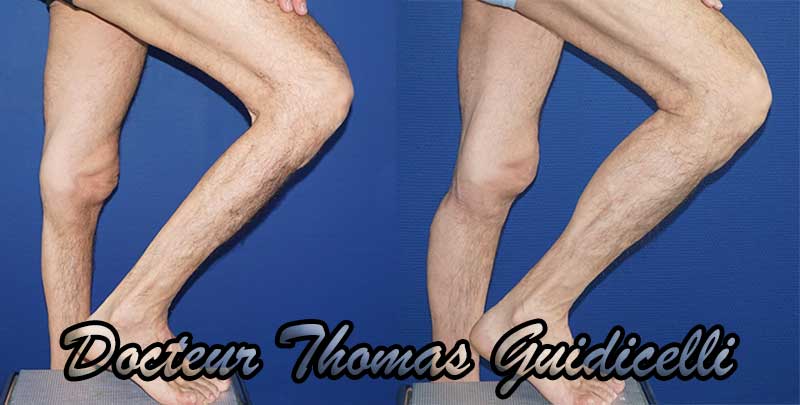 photo avant après implants mollets ou prothèse de mollet