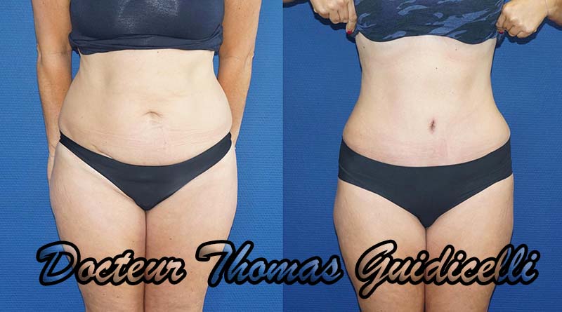 avant apres une abdominoplastie associe à une liposuccion 