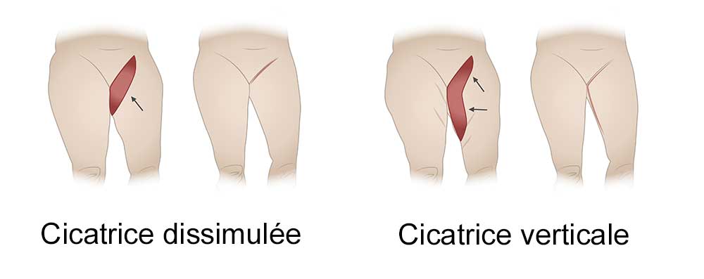 les cicatrices du lifting des cuisses