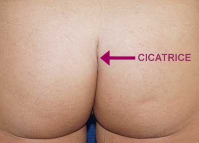 cicatrice des implants fessiers