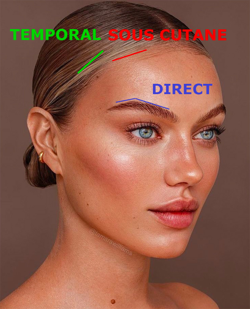 cicatrice-lifting-sourcil.jpg
