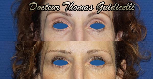 Comblement oeil creux par injection d'acide hyaluronique