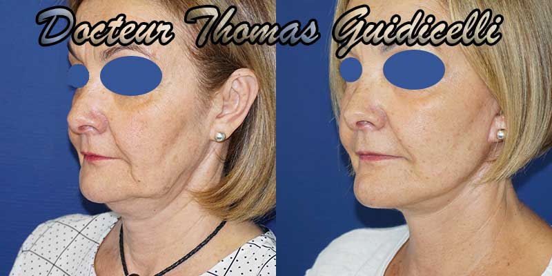 avant après un lifting du visage et du cou, restauration de l'ovale du visage