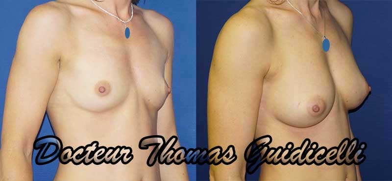 Photo avant apres lipofilling des seins marseille