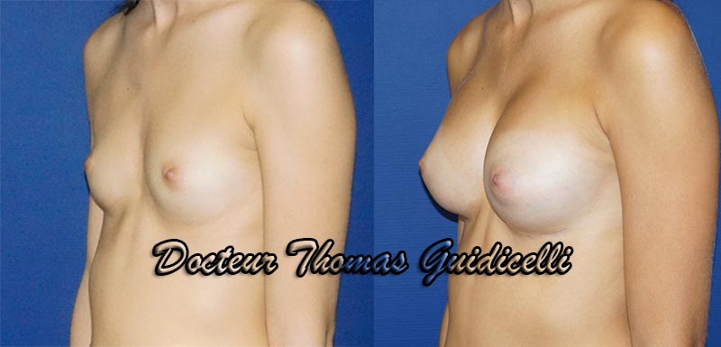 Photos avant après prothèses mammaires anatomiques 270 cc