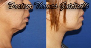 Lifting du visage cervico-facial