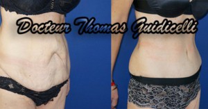 Abdominoplastie