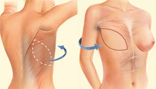 Intervention : lambeau de grand dorsal