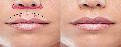 liplift.jpg