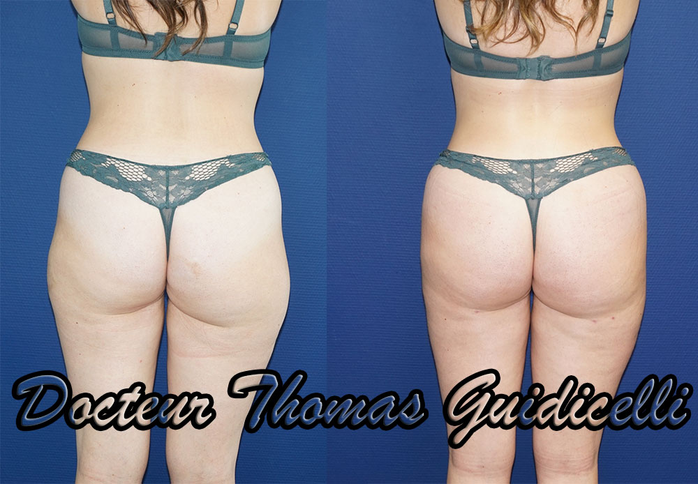résultat d'un lipofilling des fesses avec liposuccion de la culotte de cheval