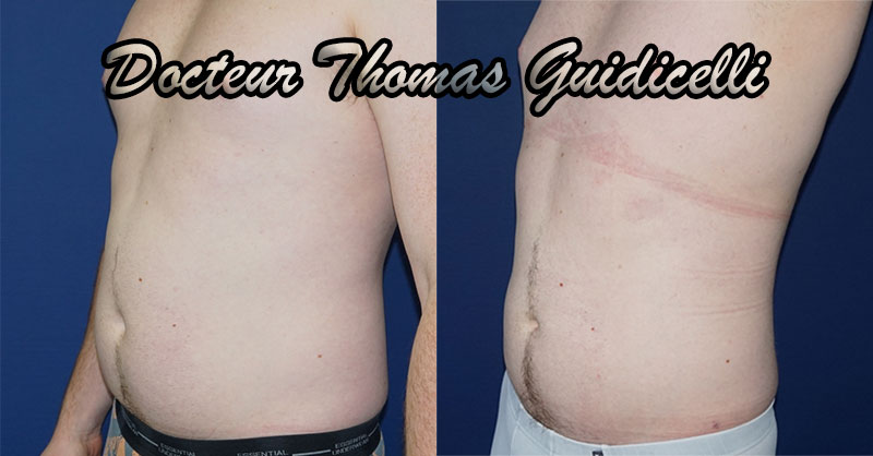 liposuccion du ventre chez l'homme