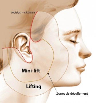 Schéma décrivant les décollements du lifting et du mini-lifting du visage
