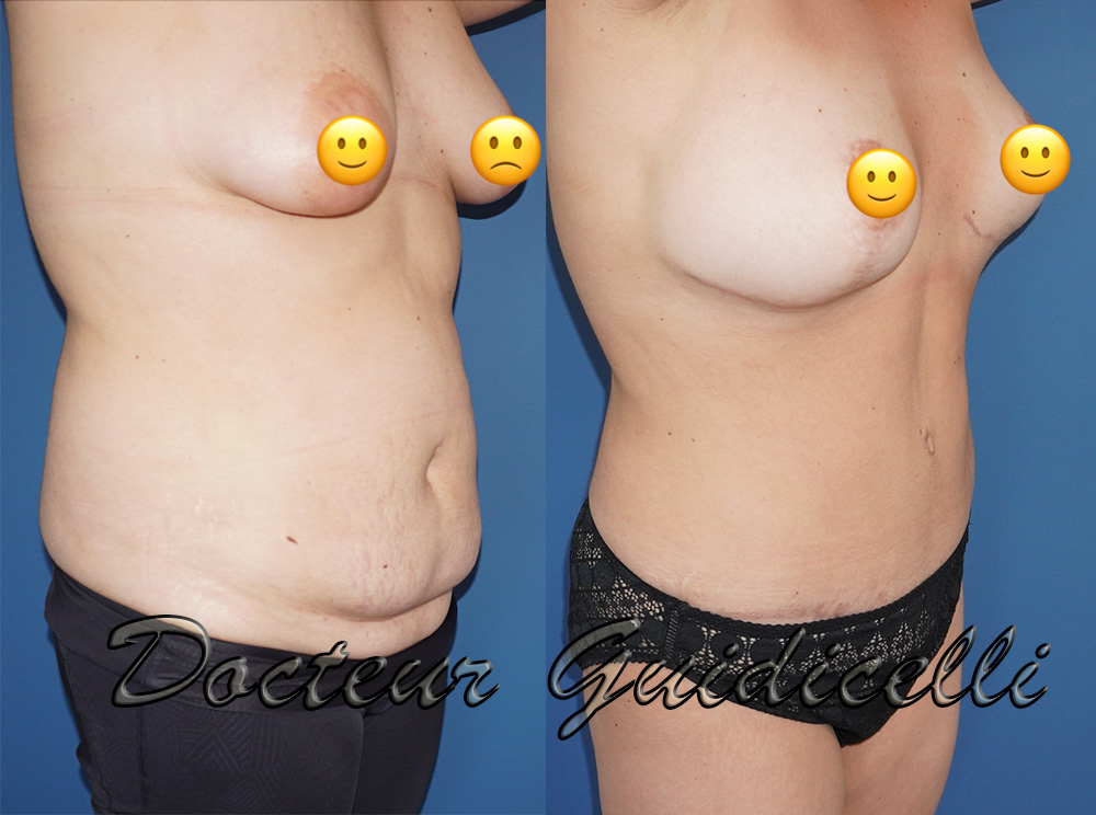 Mommy makeover avant après
