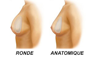 prothese mammaire ronde ou anatomique