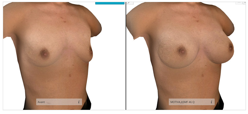 Simulation 3D augmentation mammaire par prothèses mammaires